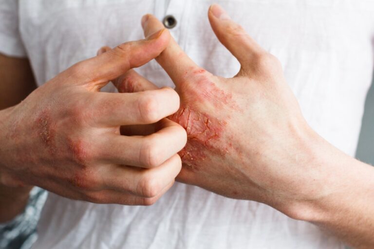remèdes naturels contre l'eczéma et les démangeaisons
