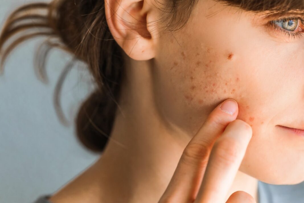 remèdes naturels de grand-mère pour combattre l'acné