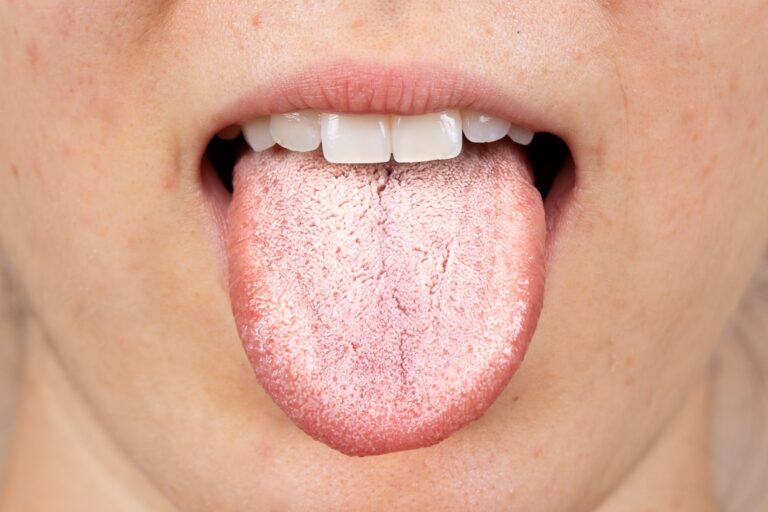 Langue blanche : 9 remèdes de grand-mère pour en venir à bout